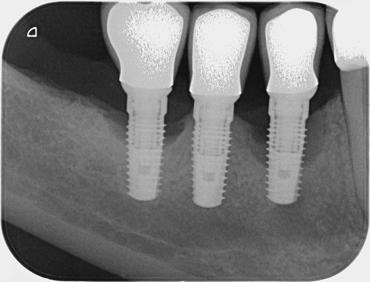 Abb. 2: Röntgenaufnahme vor Beginn der Parodontitistherapie: ausgeprägte parodontale Defekte an zwei von drei Implantaten.