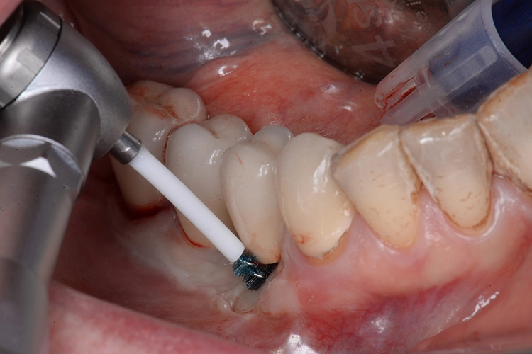 Abb. 3a: Subgingivales Debridement der betroffenen Implantate mit der Labrida BioClean™ Chitosan-Bürste 14 Tage vor der chirurgischen Intervention.