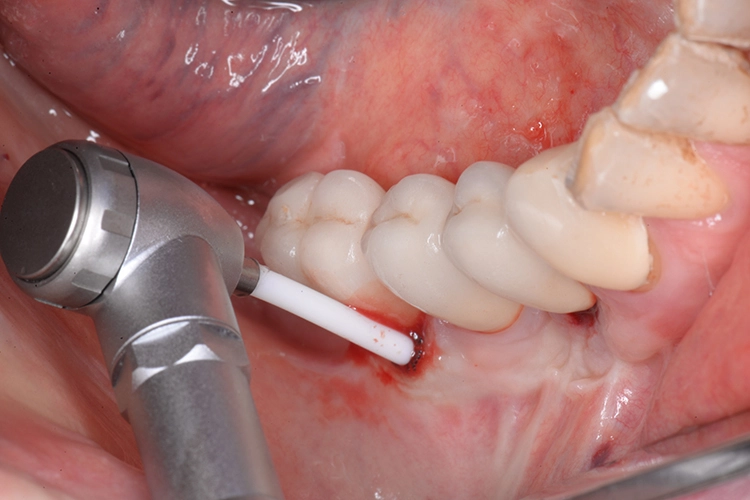 Abb. 3b: Subgingivales Debridement der betroffenen Implantate mit der Labrida BioClean™ Chitosan-Bürste 14 Tage vor der chirurgischen Intervention.