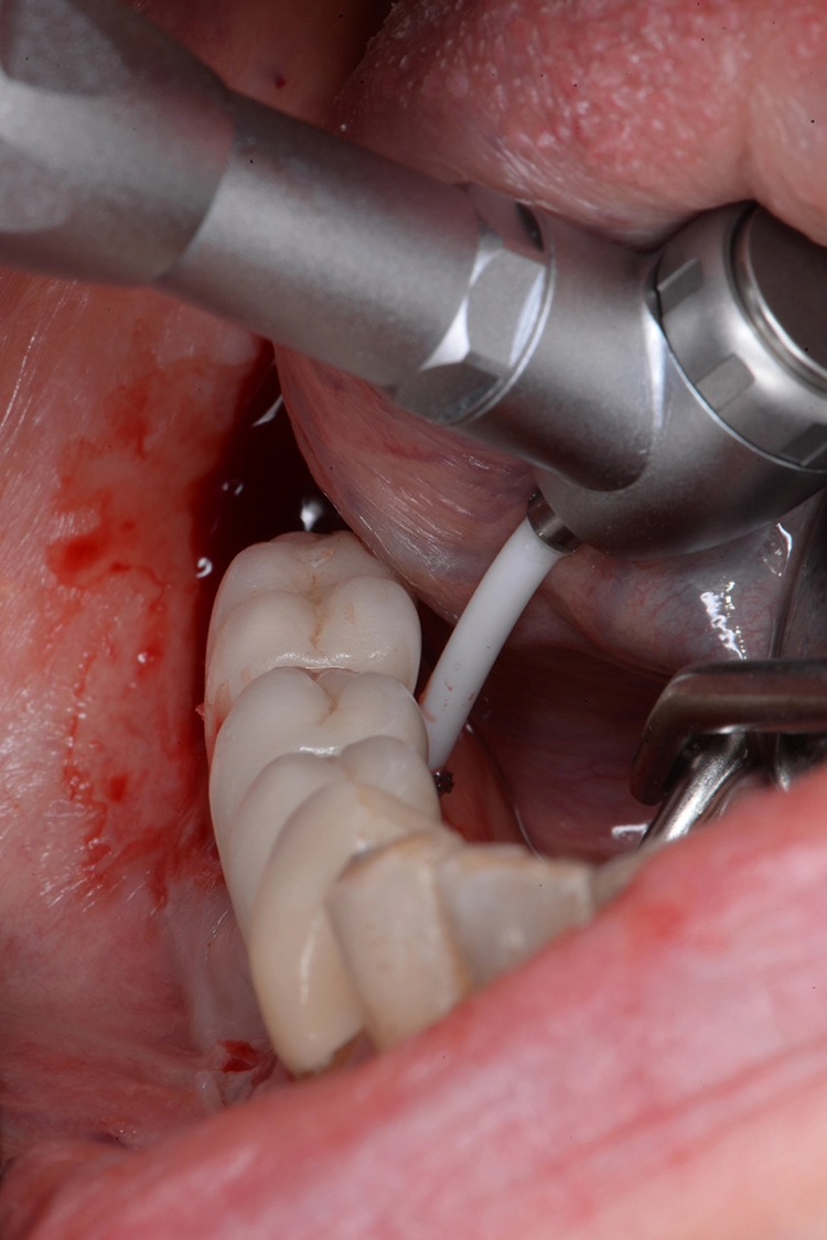 Abb. 3c: Subgingivales Debridement der betroffenen Implantate mit der Labrida BioClean™ Chitosan-Bürste 14 Tage vor der chirurgischen Intervention.