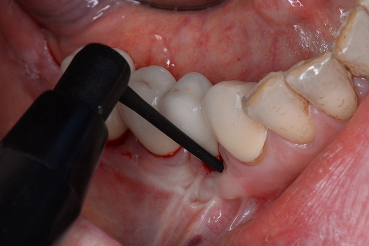 Abb. 4: Applikation des Lokalantibiotikums nach erfolgtem subgingivalem Debridement.