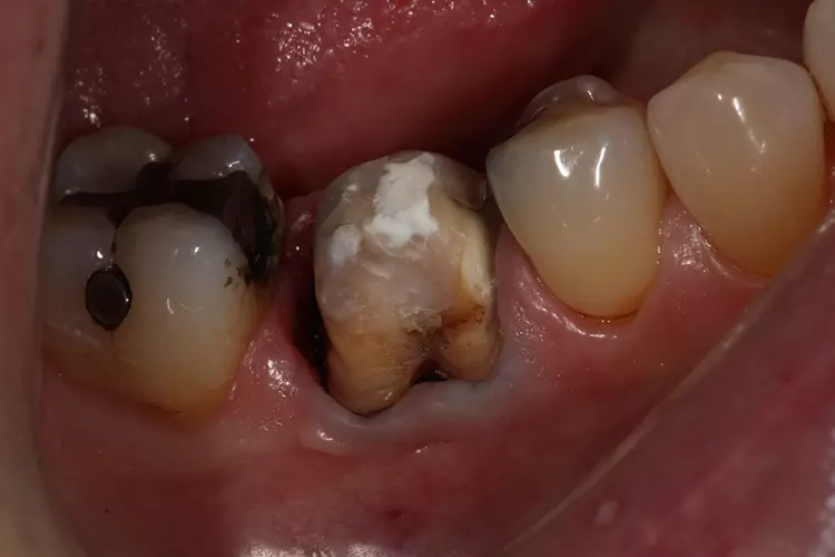 Abb. 7: Ansicht von bukkal. Nach Entfernung der
Retraction Paste, gut geweiteter gingivaler Sulkus,
ohne marginale Blutung.