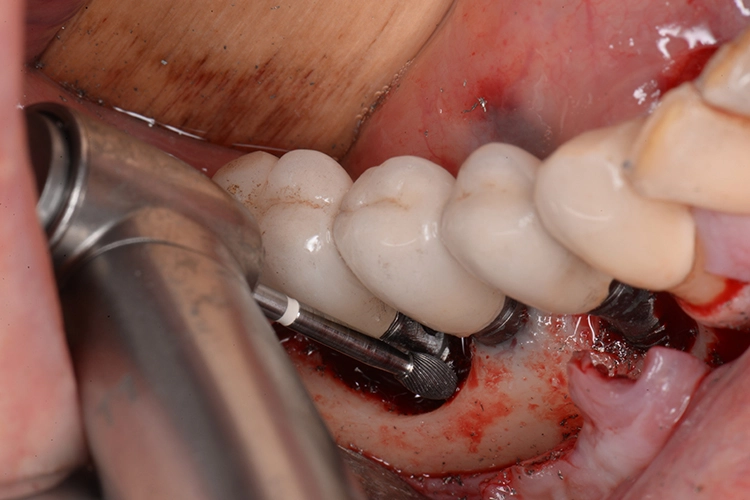 Abb. 8: Glättung der exponierten koronalen Implantatoberfläche mit Hartmetallfräsern.