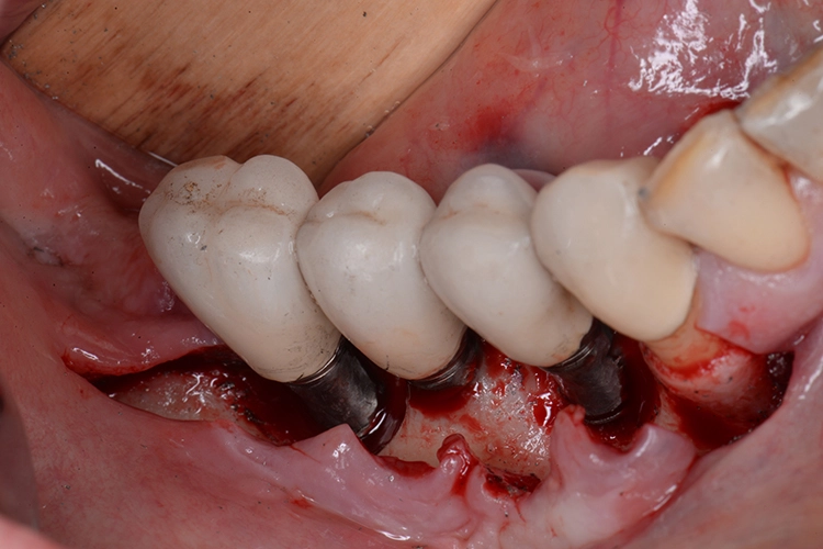 Abb. 9: Reinigung der exponierten apikalen Implantatoberfläche mit einer Titanbürste.