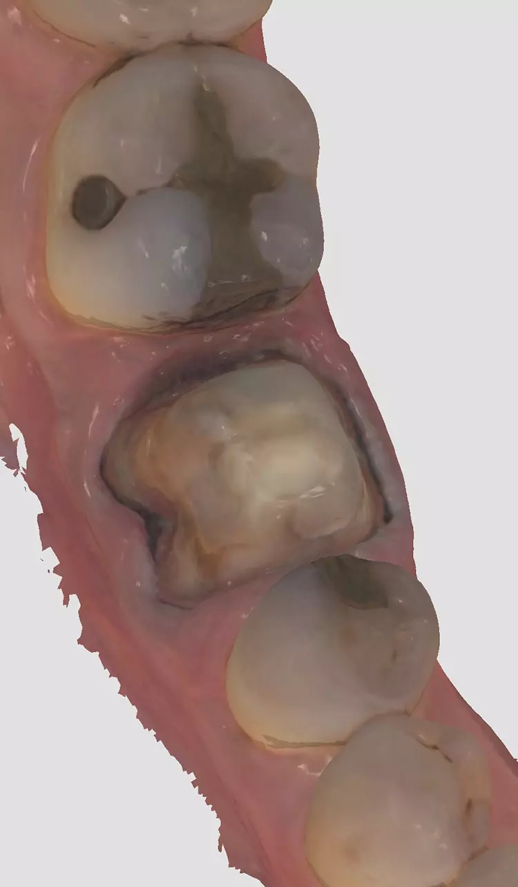 Abb. 9a: Ansicht von bukkal.
Abgeschlossener intraoraler 3D-Scan.
Sehr klarer und gut definierter Rand.