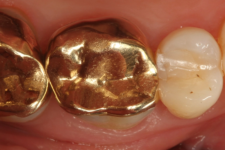 Abb. 11: Ausgangssituation: Zahn 16 mit Gold-Teilkrone; Schmerzen bei Belastung.