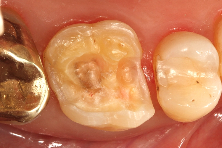 Abb. 13: Nach Exkavation der vorhandenen Karies zeigte sich eine sehr tiefe Kavität. An 2 Punkten lag offensichtlich eine Perforation des Pulpakammerdachs vor.