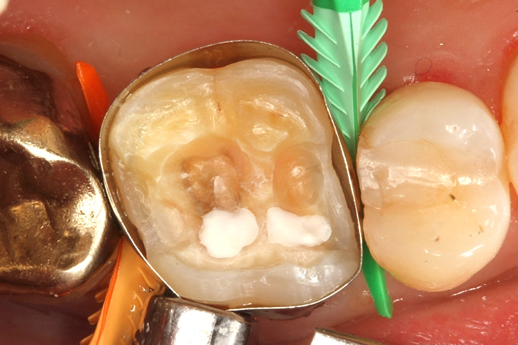 Abb. 14: Trockenlegung mit einer zirkulären, anatomisch geformten Tofflemire-Matrize und approximale Separierung und zervikale Abdichtung mit Composit-Tight-Fusion-Keilen. Die Überkappung der Pulpa erfolgte mit TheraCal LC.