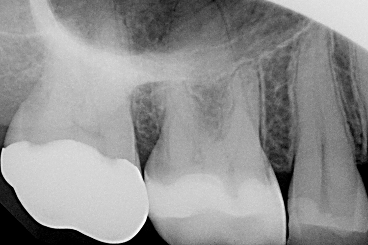 Abb. 18: Eine unmittelbar nach der Restauration angefertigte Röntgenaufnahme zur Überprüfung des Abstands zur Pulpa und der Randdichtigkeit belegt eine sehr gute Röntgensichtbarkeit von Venus Diamond ONE.
