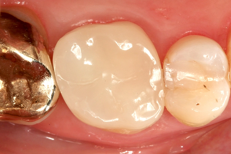 Abb. 19: Kontrollaufnahme, 4 Wochen nach der Restauration: Wiederum zeigten sich keine post-operative Überempfindlichkeit sowie eine adäquate Farbanpassung.