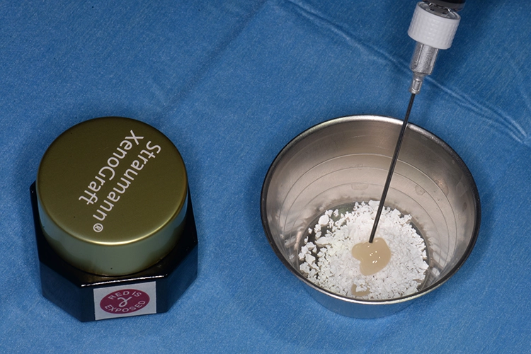 Abb. 12: Komponenten des zur Auffüllung der periimplantären Knochendefekte verwendeten Füllmaterials: Straumann® Xenograft®, Straumann® Emdogain® und autologe Knochenspäne.