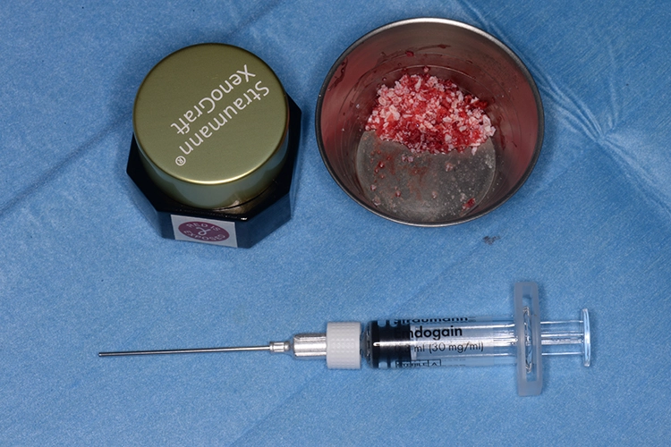 Abb. 14: Fertiges Gemisch aus Straumann® Emdogain®, Straumann® XenoGraft und autologen Knochenspänen.