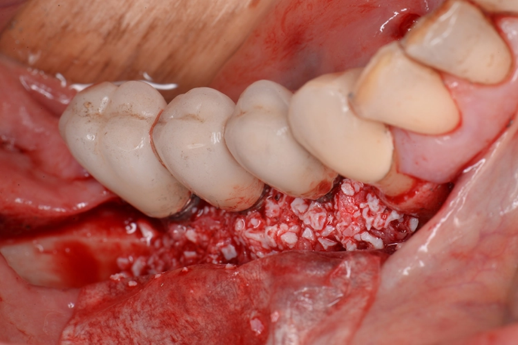 Abb. 16: Mit dem Gemisch aus XenoGraft, Emdogain® und autologen Knochenspänen sorgfältig aufgefüllte intraossäre Defekte.