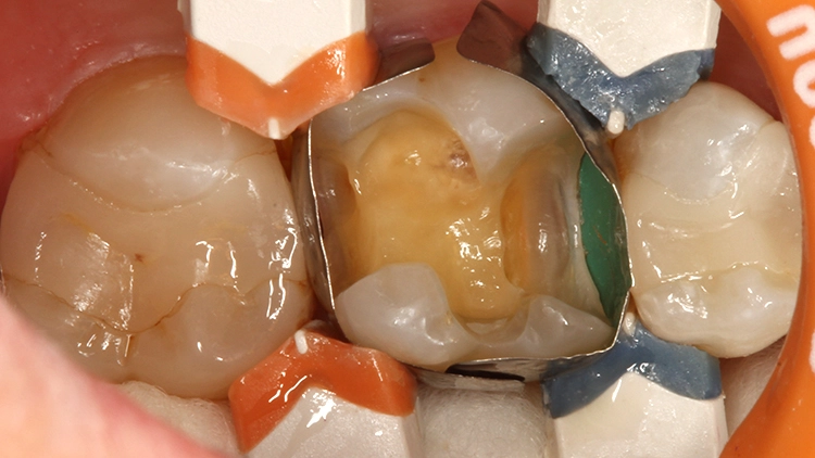 Abb. 3: Um eine Ätzung dieses Bereichs mit Phosphorsäure-Ätzgel zu vermeiden, wurde ein Universal-Adhäsiv mit selektiver Schmelzätzung mit Phosphorsäuregel angewendet.
