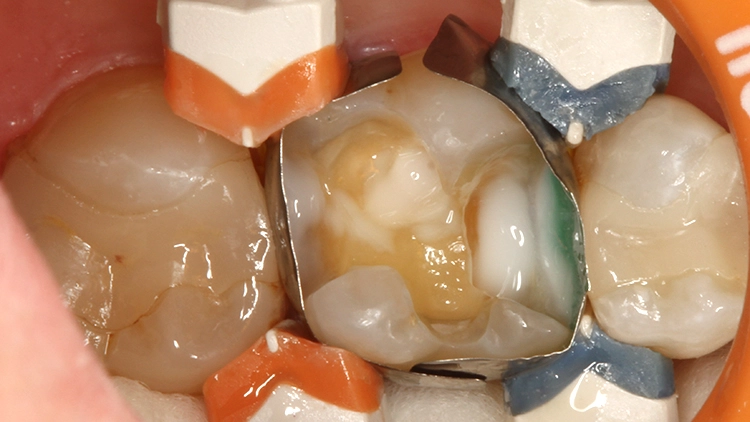 Abb. 4: Tiefe Bereiche des Kavitätenbodens und die approximalen Ränder der Kavität wurden mit einer dünnen Schicht des weiß-opaken Venus Diamond Flow Baseliners versorgt.