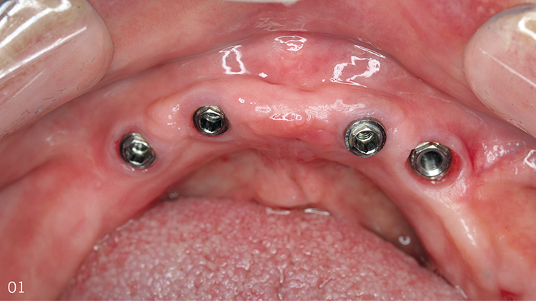 Abb. 1: Die Implantate sind im Unterkiefer korrekt positioniert und eingeheilt.