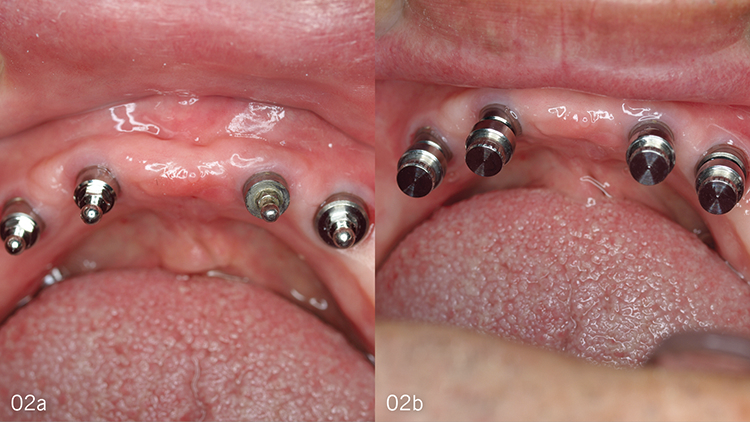 Abb. 2: (a) Die hier verwendeten Attachment-Patrizen sind Kugelkopfanker, die
auf die Abutments aufgesetzt werden. (b) Kontrolle auf korrekte Passgenauigkeit
mit den Attachment-Matrizen.