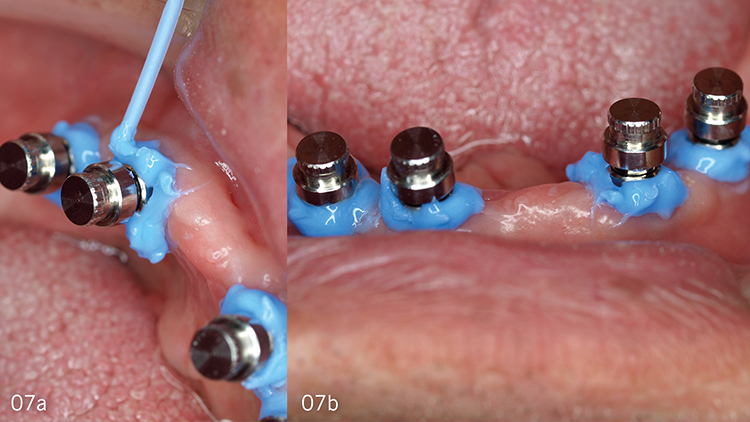 Abb. 7: (a und b) Fit Test C & B wird hier auch verwendet, um eventuelle Unterschnitte
um die Attachments in der Deckprothese, den Zähnen oder Implantaten
abzudecken und somit auszublocken.