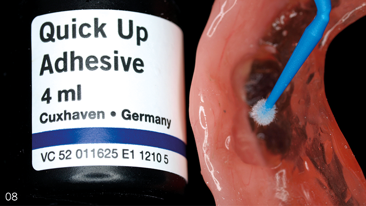 Abb. 8: Mit dem beiliegenden Applikationspinsel Single Tim (VOCO) wird Quick
Up Adhesive auf die zu verklebenden, vorbereiteten Vertiefungen auf der Unterseite
der Prothesenbasis aufgetragen.
