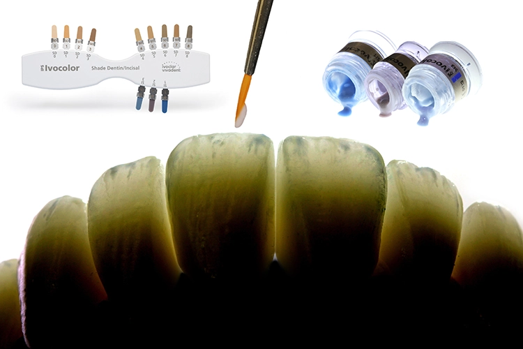 Abb. 10a: Charakterisieren des inzisalen Bereichs mit der Malfarbe IPS Ivocolor Shade Incisal.