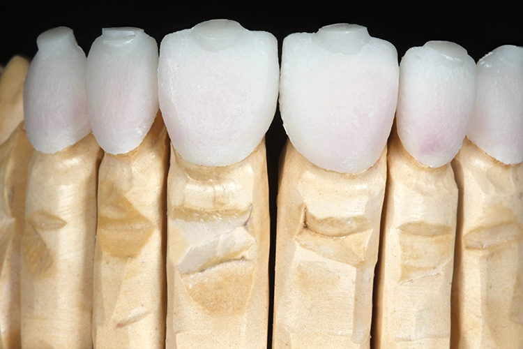 Abb. 7: Die Veneers werden aus IPS e.max Press-Rohlingen der Farbe MT BL4 gepresst, auf dem Modell aufgepasst und von der verbliebenen Reaktionsschicht befreit. Dann erfolgt eine natürliche Charakterisierung mittels Scoop-Technik: Form, Konturen und Textur der Restaurationen werden verfeinert und kleine Wölbungen – Scoops – in den palatinalen/inzisalen Bereichen angelegt.