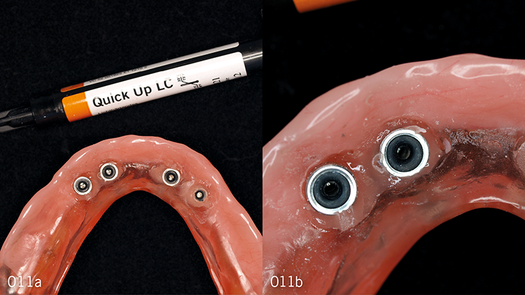 Abb. 11: (a) Quick Up, lichthärtende Variante. (b) Einige Bereiche um die Verankerungen
herum sind nicht vollständig mit Quick Up gefüllt.