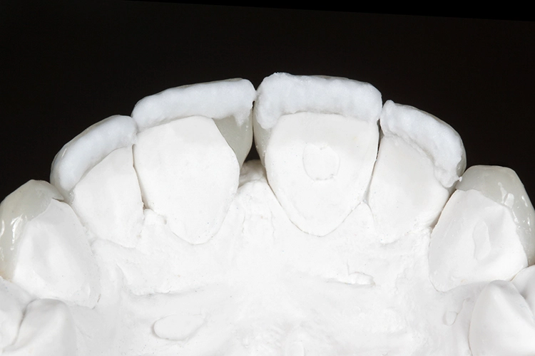 Abb. 10: Nach einer letzten Schicht Transpa Incisal-Masse (TI 1) wird gebrannt und schließlich poliert.