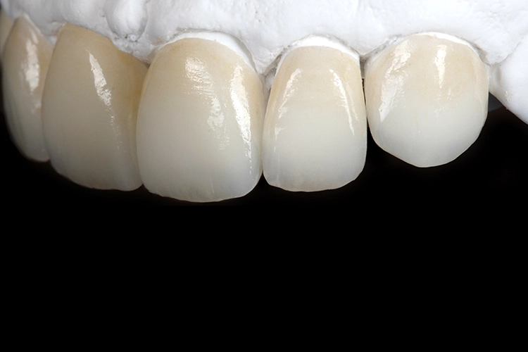 Abb. 11a u. b: Die fertiggestellten Veneers auf dem Modell überzeugen mit einem natürlich wirkenden Zusammenspiel von Textur und Transluzenz sowie einer harmonischen Gestaltung der Schneidekanten inklusive Halo-Effekt ebenso wie der Zervikalbereiche und Randleisten, wodurch die Interdentalräume besonders plastisch erscheinen. Die Vitalität, welche die Restaurationen ausstrahlen, ist dabei nicht zuletzt auf die Keramik IPS e.max Press MT zurückzuführen.