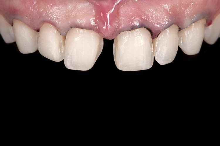 Abb. 3: Im Sinne einer konservierenden Zahnheilkunde und als optimale Grundlage für eine adhäsive Befestigung der geplanten Veneers wird bei der Präparation möglichst viel Zahnschmelz erhalten.