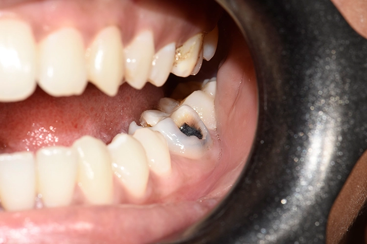 Abb. 1a: Ausgangssituation: endodontisch infizierten Backenzahn.