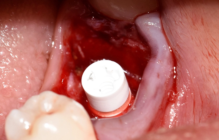 Abb. 4b: Implantat regio 36 (bukkale Ansicht).