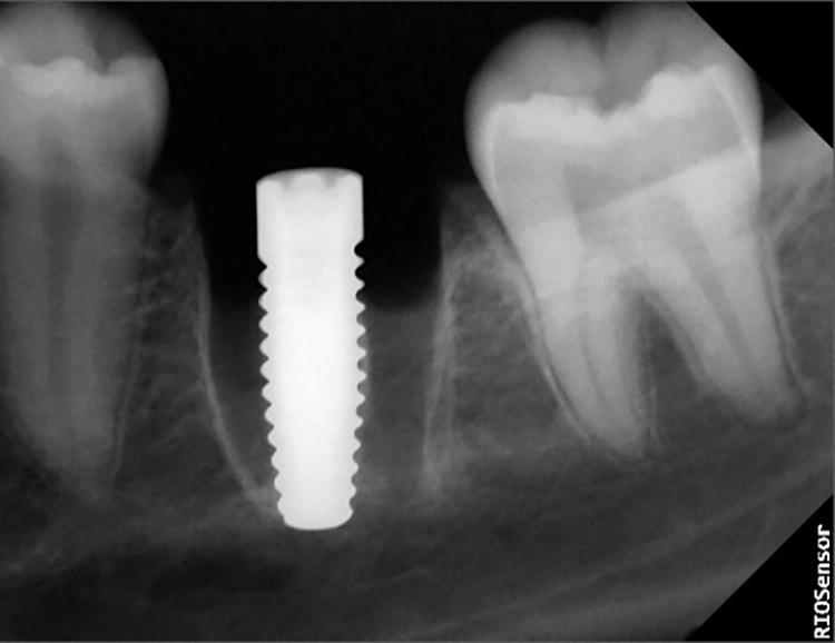 Abb. 4d: Röntgenbild des Implantats regio 36.