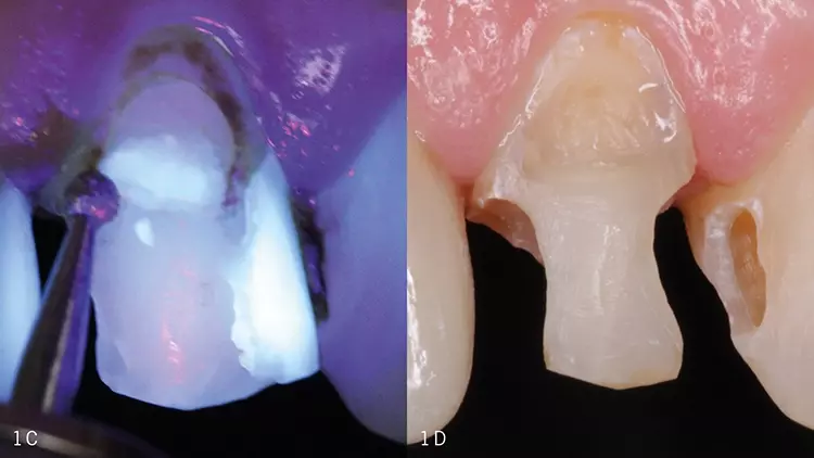Abb. 1C u. D: Entfernung der defekten Restaurationen unter UV-Lichtquelle
und mit einem kugelförmigen Diamantbohrer.
