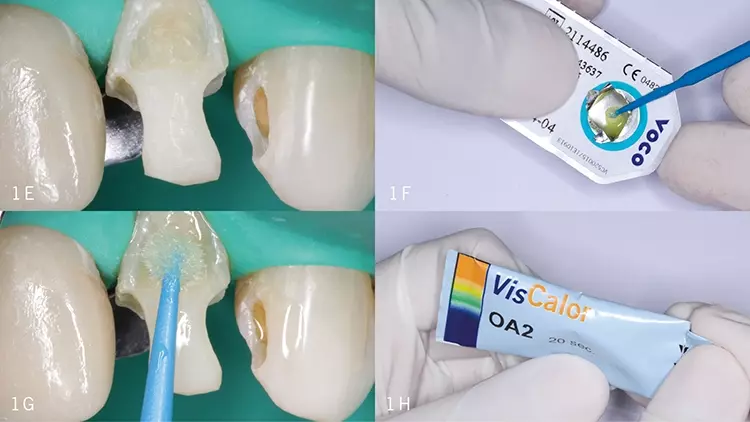 Abb. 1E: Trockenlegung mit Kofferdam.
Abb. 1F u. G: Universaladhäsiv Futurabond U (VOCO) wurde gemischt und
dann 20 Sek. lang einmassiert.
Abb. 1H: VisCalor Caps wurden aus der Blisterverpackung entnommen...