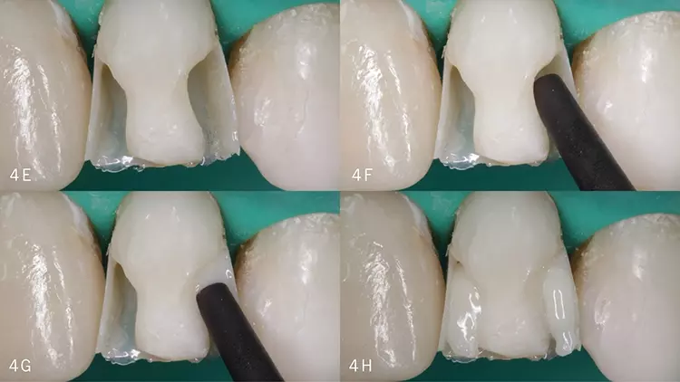 Abb. 4D u. E: Bei der distalen Kavität wurde analog vorgegangen.
Abb. 4F–H: Wiederherstellung des Dentinkerns im Farbton OA2.