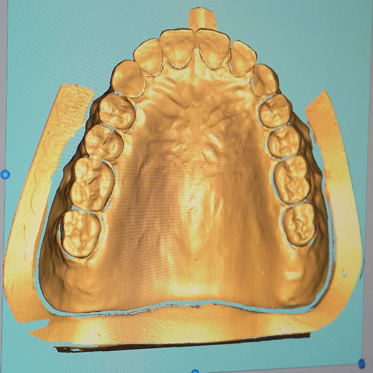 Scanergebnisse einer Vollprothese mit Scantist 3D.