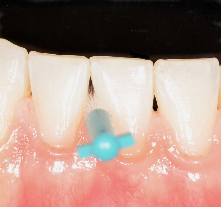 Abb. 2: Auswahl der passenden Interdentalraumbürste.
a) zu klein: CPS 06 prime, PHD = 0,6 mm. Die Interdentalraumbürste füllt den Interdentalraum nicht aus und lässt sich drucklos ein- und ausführen.