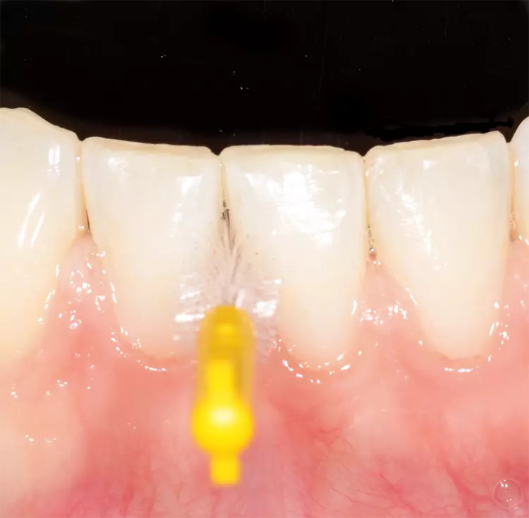 Abb. 2 b) passend: CPS 09 prime, PHD = 0,9 mm. Der gesamte Interdentalraum wird gereinigt, die Interdentalraumbürste lässt sich mit mittlerem Druck ein- und ausführen.