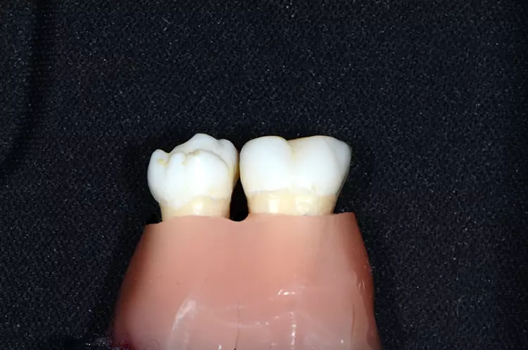 Abb. 3 b–d) Anwendung am Echtzahnmodell mit simuliertem parodontalem Knochenabbau und großem Interdentalraum. Während die linke Interdentalraumbürste korrekt angepasst wurde und regelgerecht angewendet werden kann, ist eine Insertion der rechten Bürste trotz gleicher ISO-Größe nicht möglich.