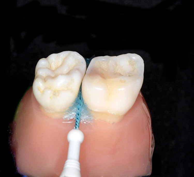 Abb. 3 c) Anwendung am Echtzahnmodell mit simuliertem parodontalem Knochenabbau und großem Interdentalraum. Während die linke Interdentalraumbürste korrekt angepasst wurde und regelgerecht angewendet werden kann, ist eine Insertion der rechten Bürste trotz gleicher ISO-Größe nicht möglich.