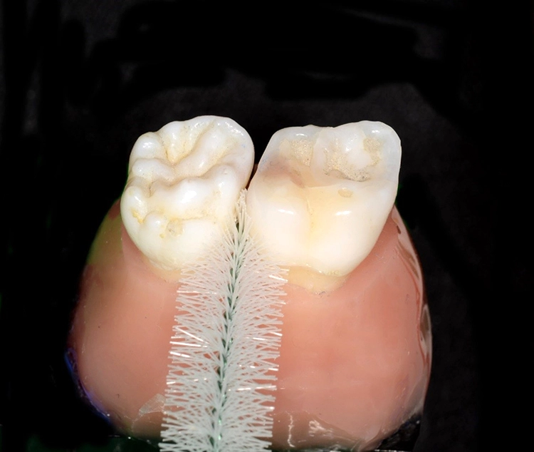 Abb. 3 d) Anwendung am Echtzahnmodell mit simuliertem parodontalem Knochenabbau und großem Interdentalraum. Während die linke Interdentalraumbürste korrekt angepasst wurde und regelgerecht angewendet werden kann, ist eine Insertion der rechten Bürste trotz gleicher ISO-Größe nicht möglich.