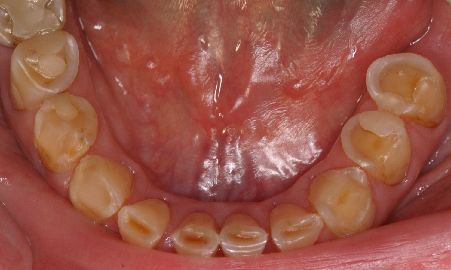 Abb. 3: Typischer klinischer Aspekt bei Hyposalivation: glanzlose
Schleimhaut, matte Zahnoberflächen und fehlender Speichelsee
im Sublingualraum bei einer Patientin mit Sjögren-Syndrom.