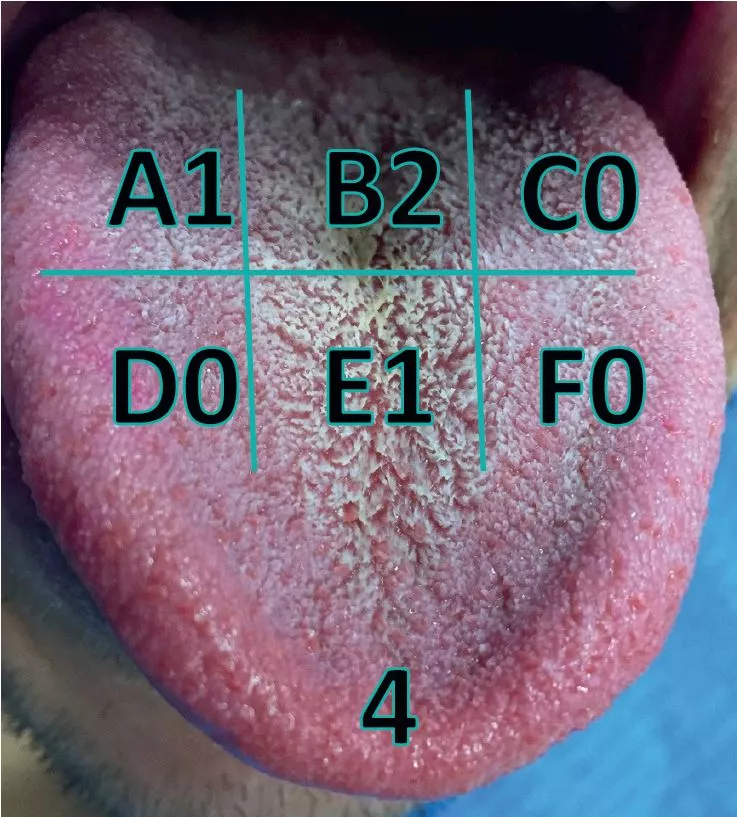 Abb. 1: Winkel tongue coating index (WTCI).