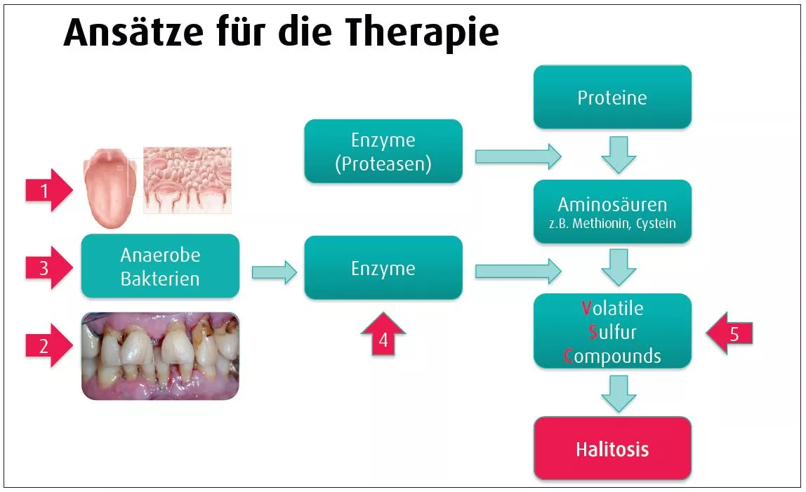 Abb. 2: Entstehung flüchtiger Schwefelverbindungen (VSC) und Therapieansätze: 1. mechanische Zungenreinigung; 2. systematische Parodontitistherapie; 3. Antiseptika (z.B. Mundspüllösungen); 4. Hemmung der proteolytischen Enzyme;
5. Maskierung vorhandener VSC (Komplexbildung).