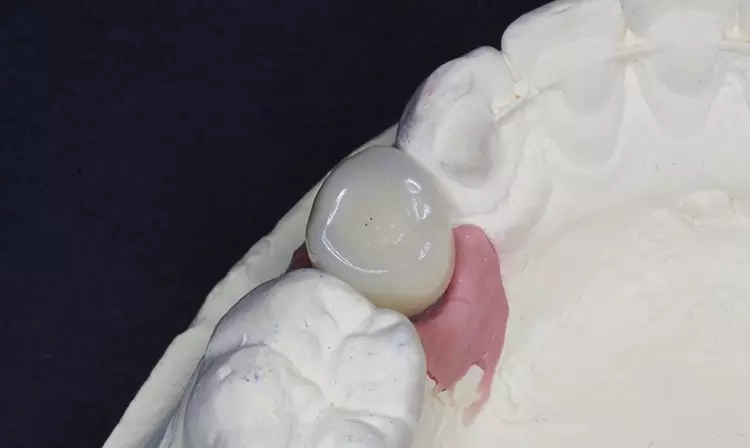 Keramikkrone auf Implantat.