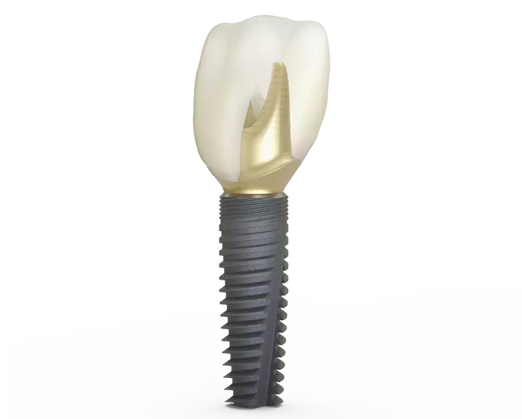 Die bewährte EVmit One-position-only für Atlantis Abutments wurde speziell für digitale Arbeitsabläufe entwickelt.