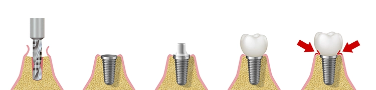 Implantate brauchen viel Pflege – verursacht durch den Engpass zwischen Gingiva und Implantat-Hals.