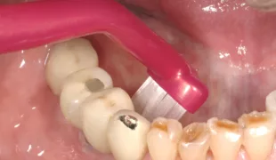 Mit individuellen Pflegemaßnahmen lässt sich das Risiko periimplantärer Erkrankungen vermindern – diese müssen aber auf einer umfassenden Risikobewertung beruhen.