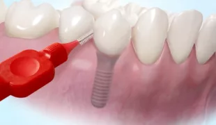 Das A und O bei der Implantat-Pflege ist die akribische Reinigung der das Implantet umgebenden Zahnfleischsäume, z.B. mittels Interdentalbürste. Wer hierfür Ajona einsetzt, begnetet damit den verschiedenen Leitkeimen nachweislich effektiv.