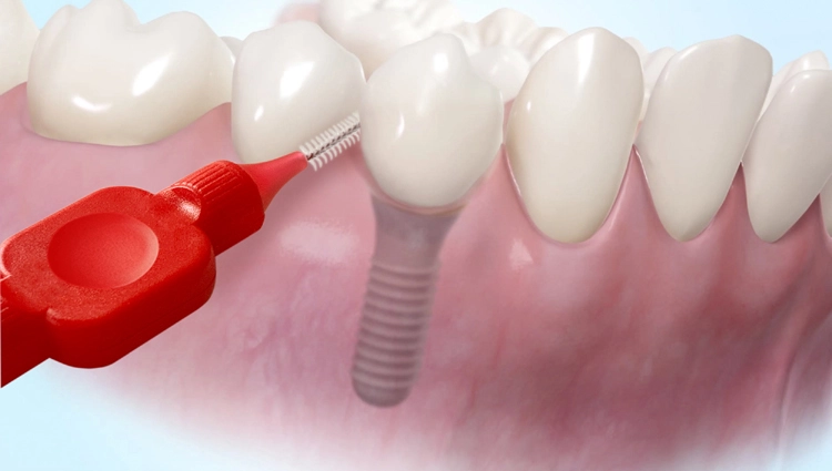 Das A und O bei der Implantat-Pflege ist die akribische Reinigung der das Implantet umgebenden Zahnfleischsäume, z.B. mittels Interdentalbürste. Wer hierfür Ajona einsetzt, begnetet damit den verschiedenen Leitkeimen nachweislich effektiv.